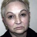 Facelift Before & After Patient #4377