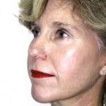 Facelift Before & After Patient #4360