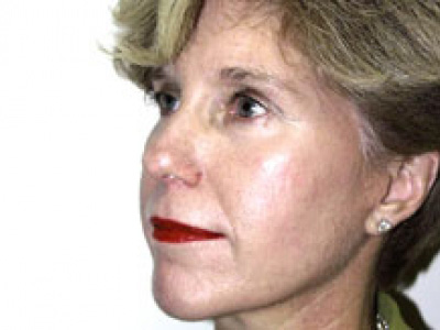Facelift Before & After Patient #4360