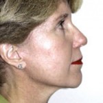 Facelift Before & After Patient #4360