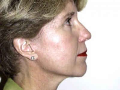 Facelift Before & After Patient #4360