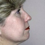 Facelift Before & After Patient #4360