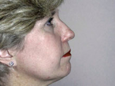 Facelift Before & After Patient #4360