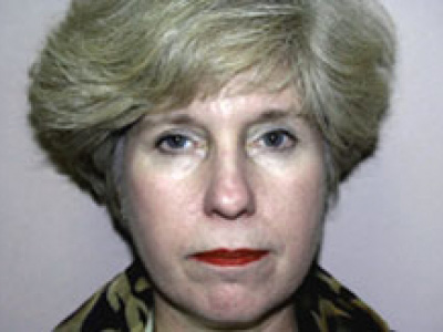 Facelift Before & After Patient #4360