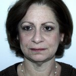 Facelift Before & After Patient #4983