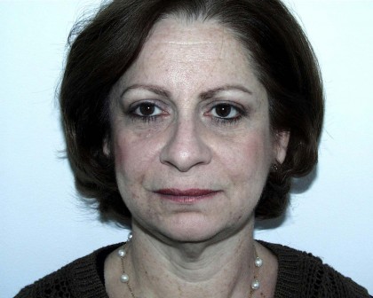 Facelift Before & After Patient #4983