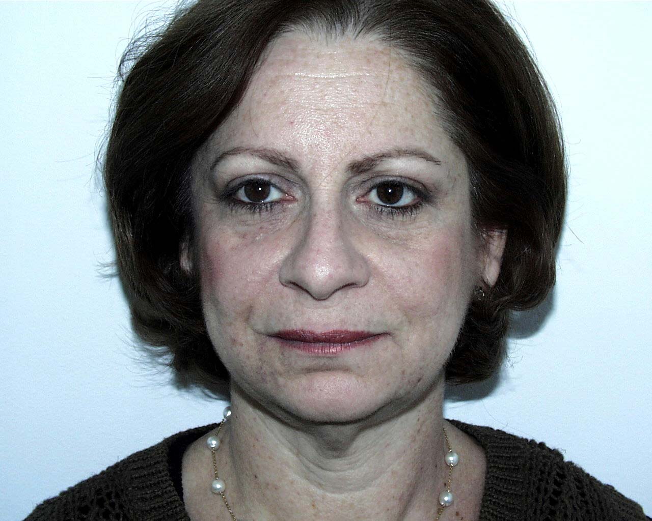 Facelift Before & After Patient #4983