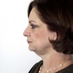 Facelift Before & After Patient #4983