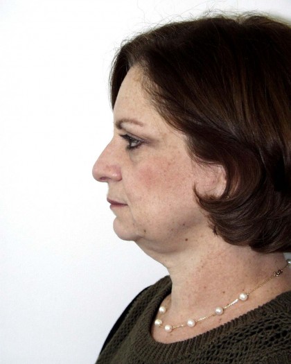 Facelift Before & After Patient #4983