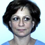 Facelift Before & After Patient #4983