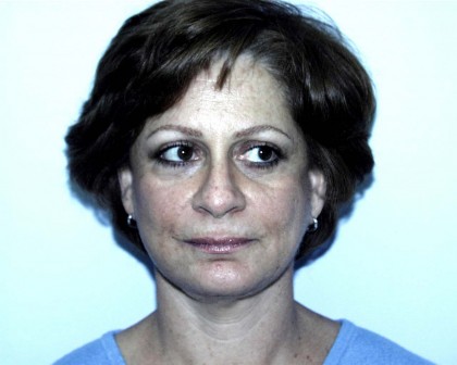 Facelift Before & After Patient #4983