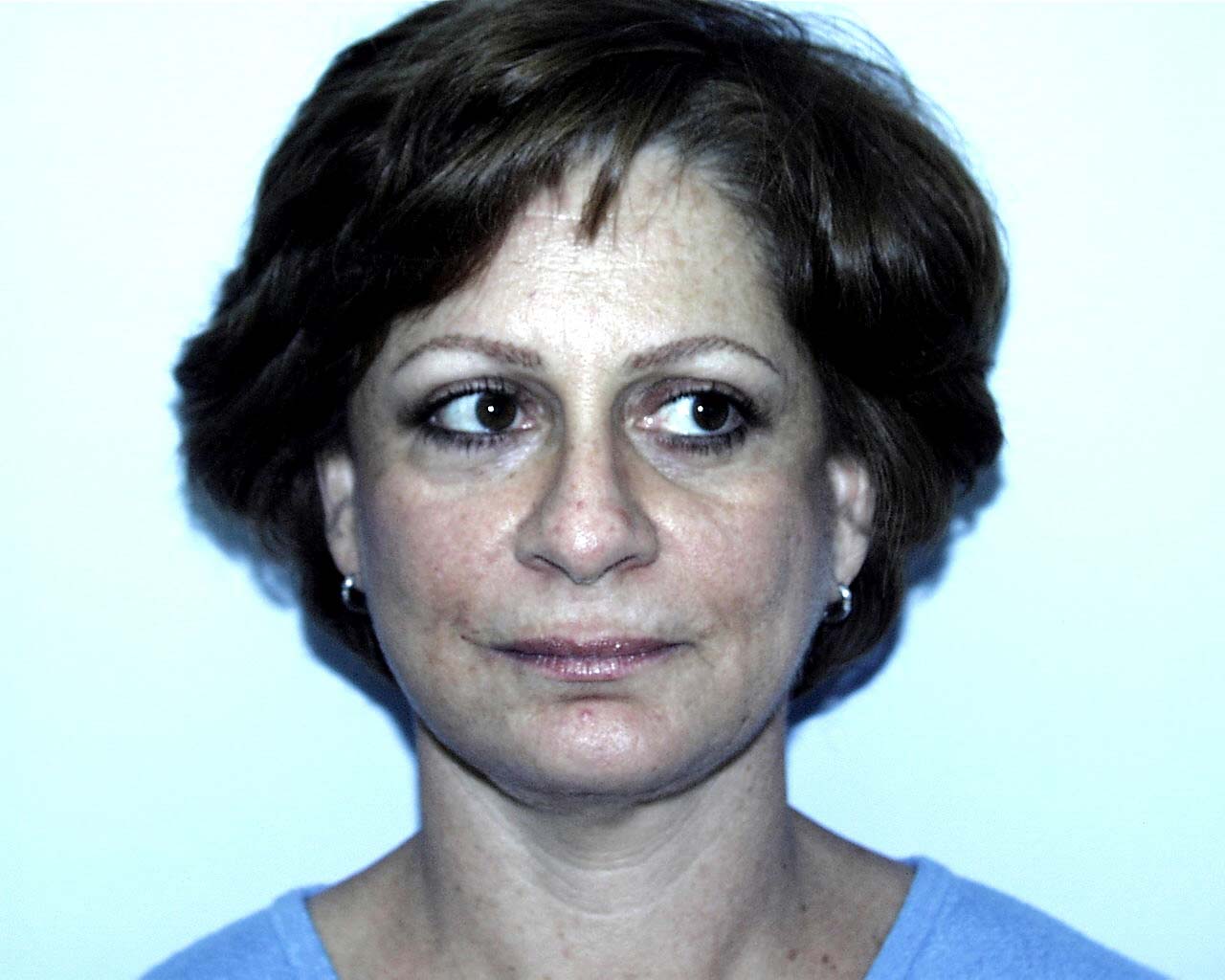 Facelift Before & After Patient #4983