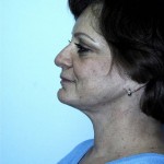 Facelift Before & After Patient #4983