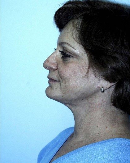 Facelift Before & After Patient #4983