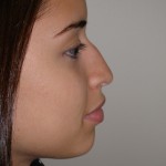 Rhinoplasty Before & After Patient #4128