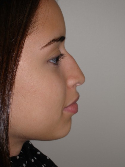 Rhinoplasty Before & After Patient #4128