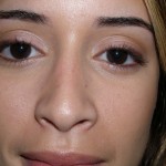 Rhinoplasty Before & After Patient #4128