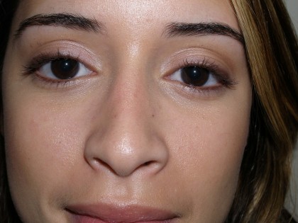 Rhinoplasty Before & After Patient #4128