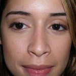 Rhinoplasty Before & After Patient #4128
