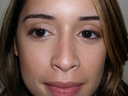 Rhinoplasty Before & After Patient #4128