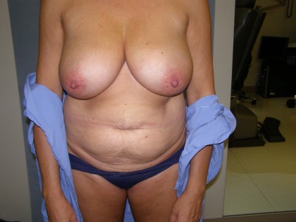 Breast Lift Before & After Patient #4011