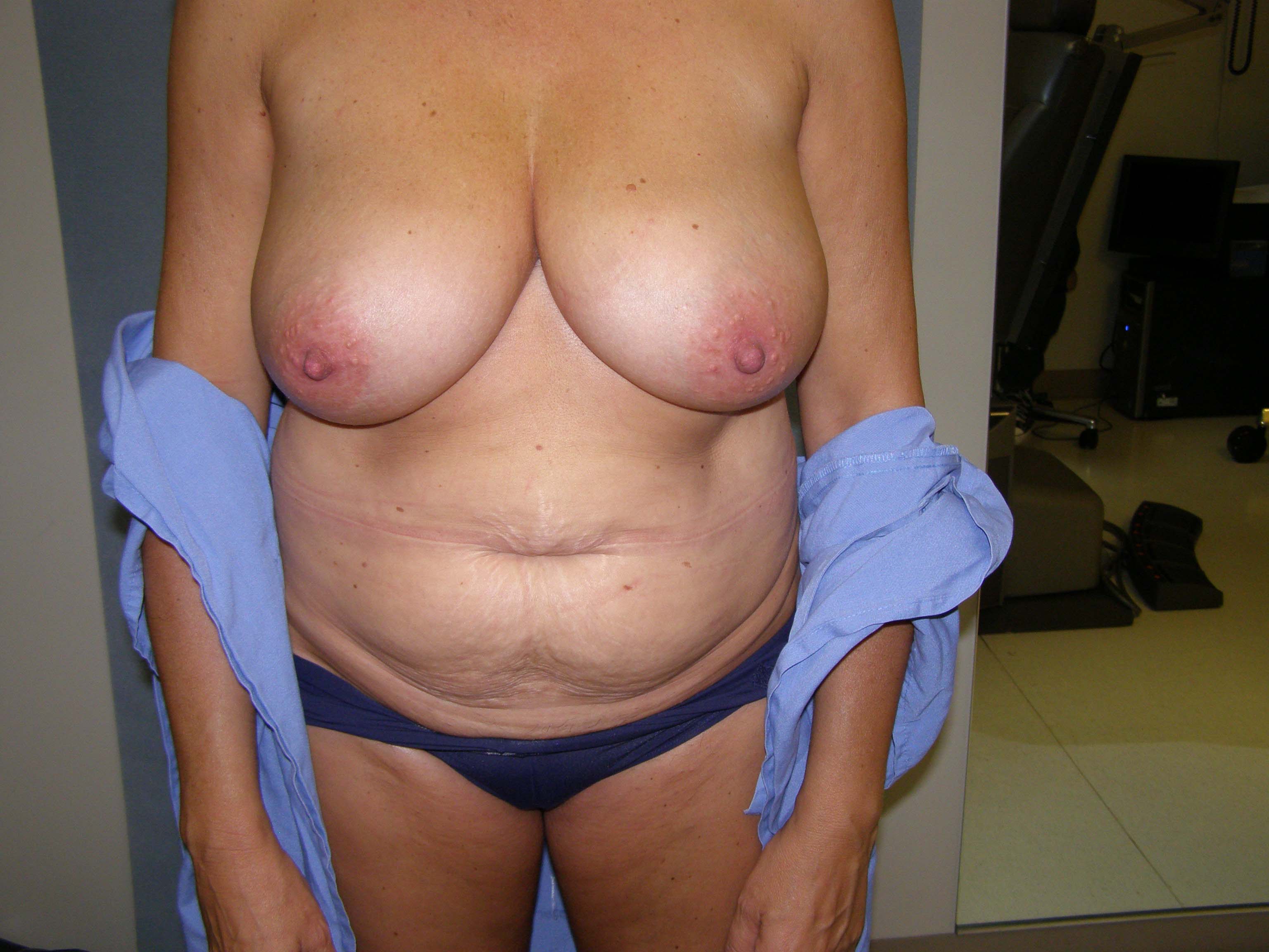 Breast Lift Before & After Patient #4011