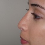 Rhinoplasty Before & After Patient #4128
