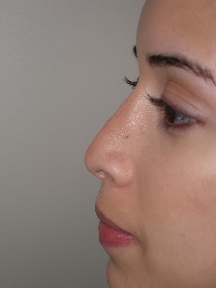Rhinoplasty Before & After Patient #4128