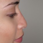 Rhinoplasty Before & After Patient #4128