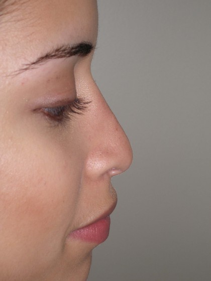 Rhinoplasty Before & After Patient #4128