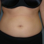 Tummy Tuck Before & After Patient #4023