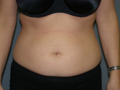 Tummy Tuck Before & After Patient #4023