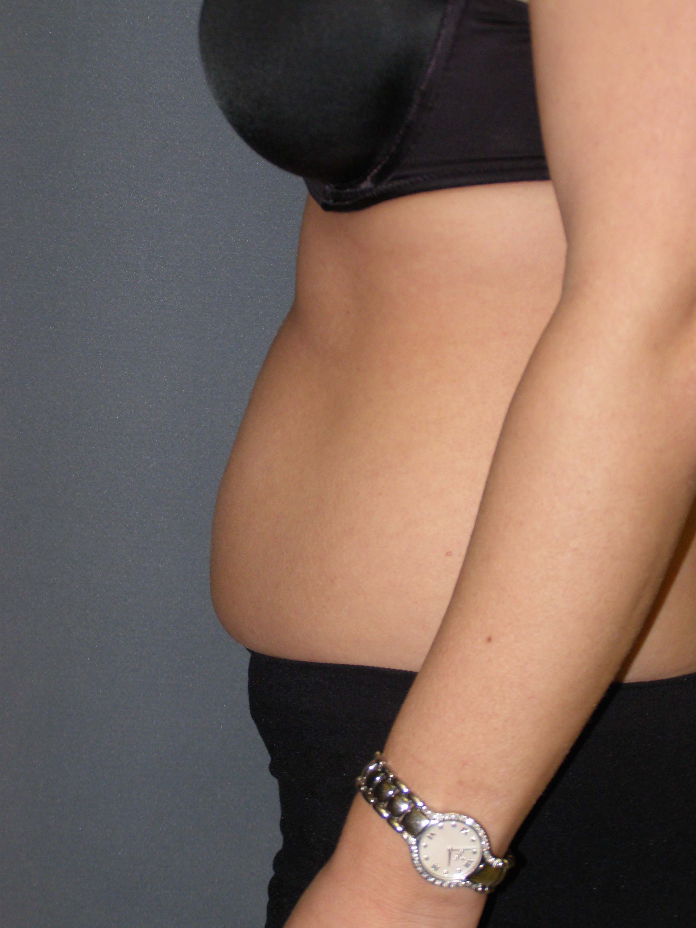 Tummy Tuck Before & After Patient #4023