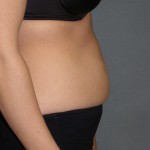 Tummy Tuck Before & After Patient #4023