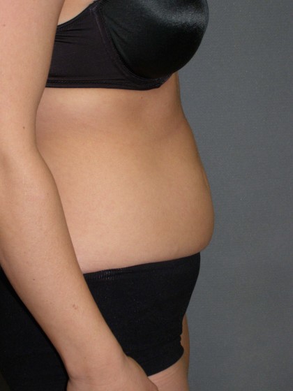 Tummy Tuck Before & After Patient #4023