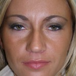 Rhinoplasty Before & After Patient #4146