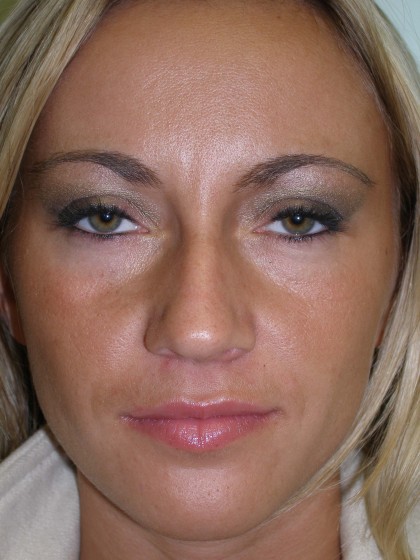 Rhinoplasty Before & After Patient #4146