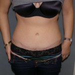 Tummy Tuck Before & After Patient #4023