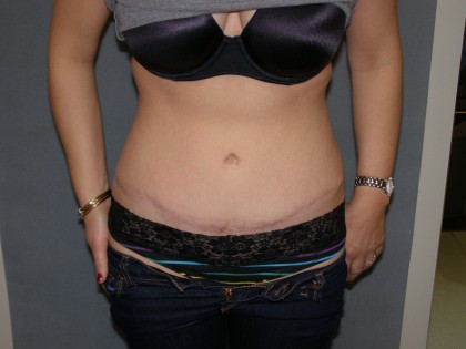 Tummy Tuck Before & After Patient #4023