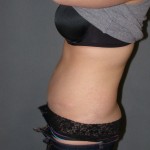 Tummy Tuck Before & After Patient #4023
