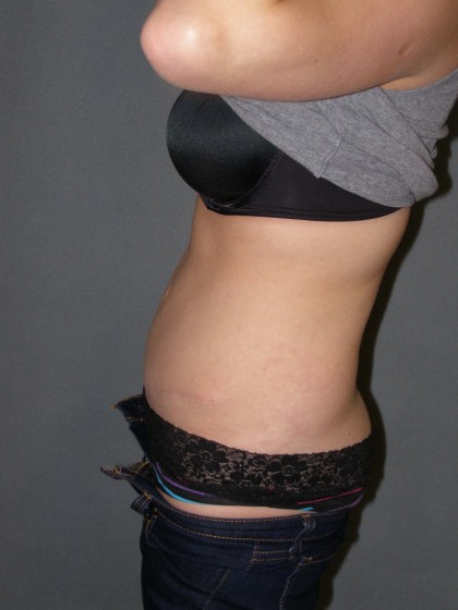 Tummy Tuck Before & After Patient #4023
