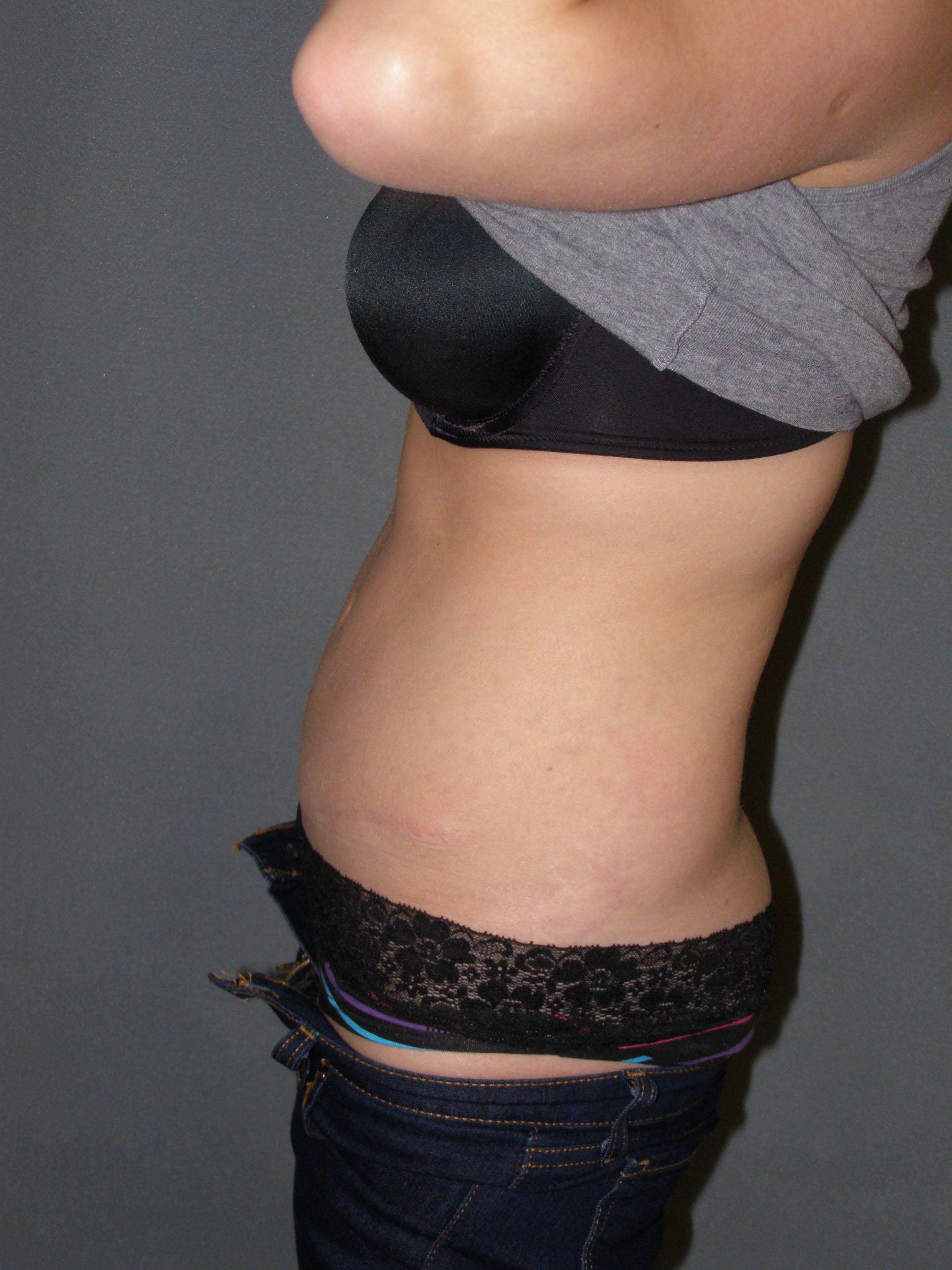 Tummy Tuck Before & After Patient #4023