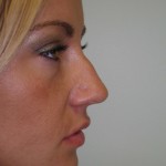 Rhinoplasty Before & After Patient #4146