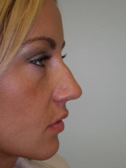 Rhinoplasty Before & After Patient #4146