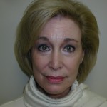 Facelift Before & After Patient #4988