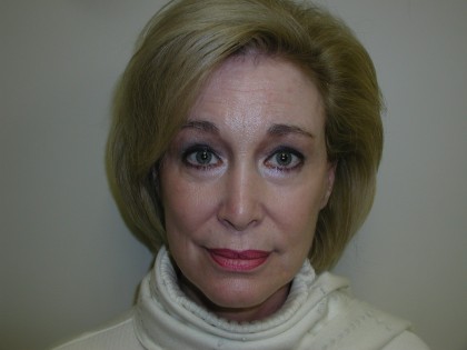 Facelift Before & After Patient #4988