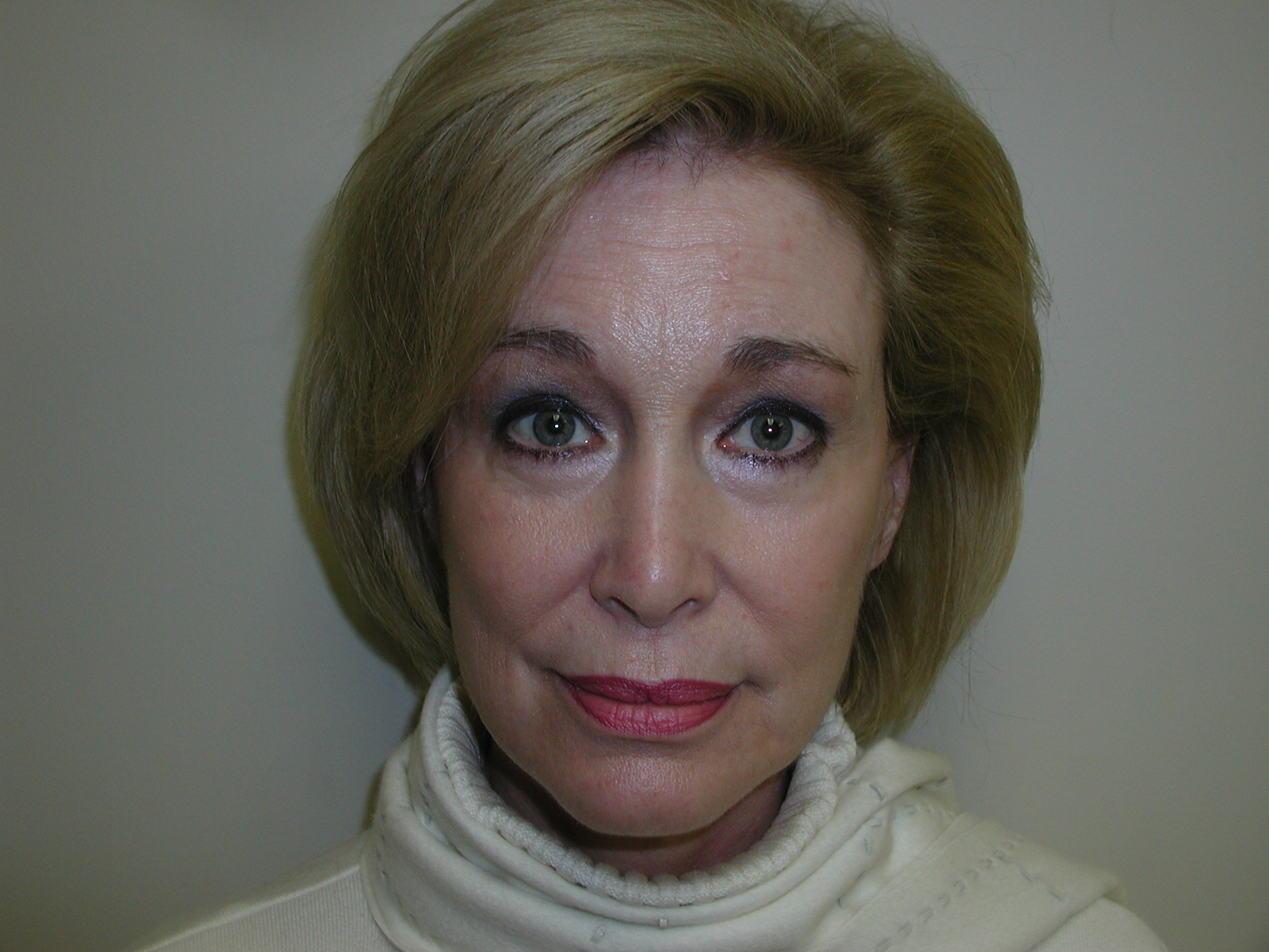Facelift Before & After Patient #4988