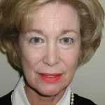 Facelift Before & After Patient #4988