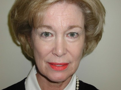Facelift Before & After Patient #4988