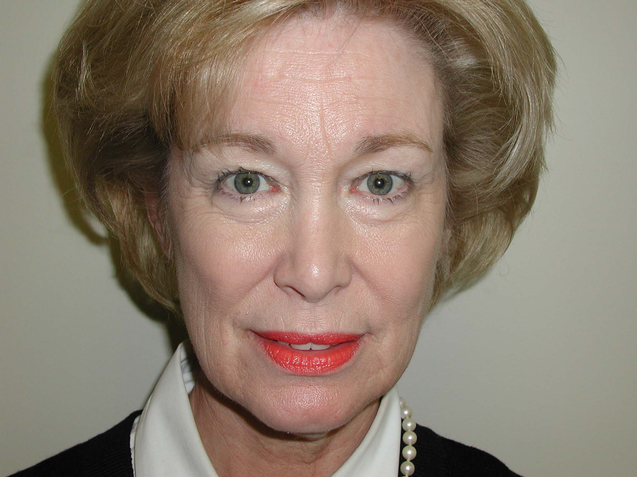 Facelift Before & After Patient #4988